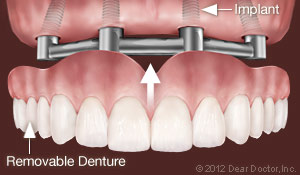 Dental Implants Support Removable Dentures.